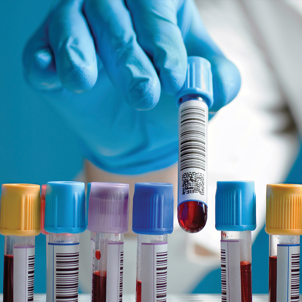 Νέα, πρωτοποριακή εξέταση αίματος ανιχνεύει 8 καρκίνους