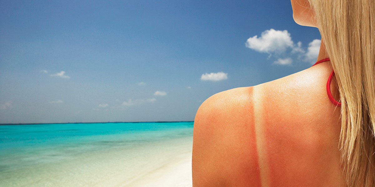 how to remove sunburn