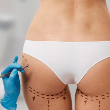 woman-marked-out-cosmetic-surgery