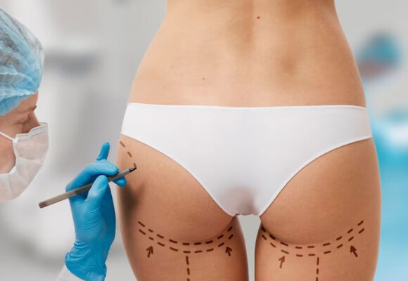 woman-marked-out-cosmetic-surgery